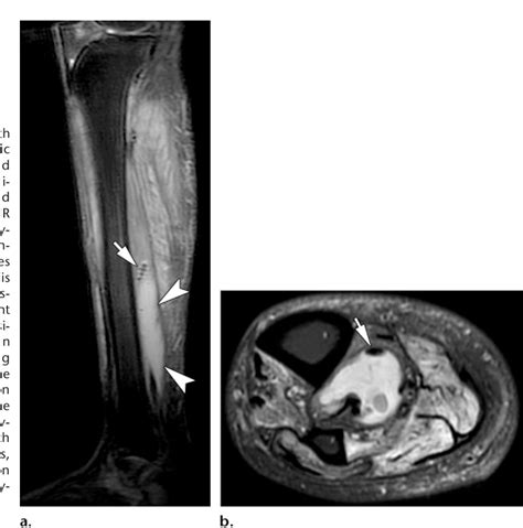 Figure 5 From Soft Tissue Infections And Their Imaging Mimics From