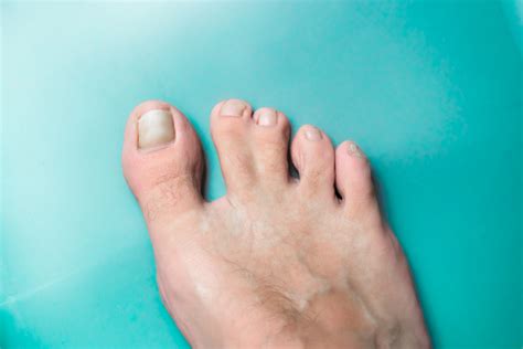 Are Webbed Toes An Inherited Trait