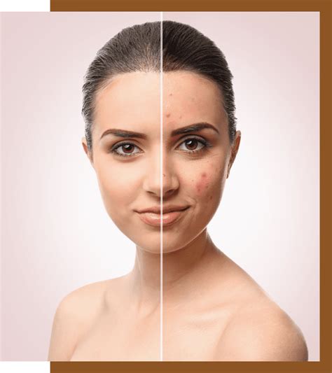 How To Get Rid Of Acne Scars Types Treatment Cost And Prevention Tips