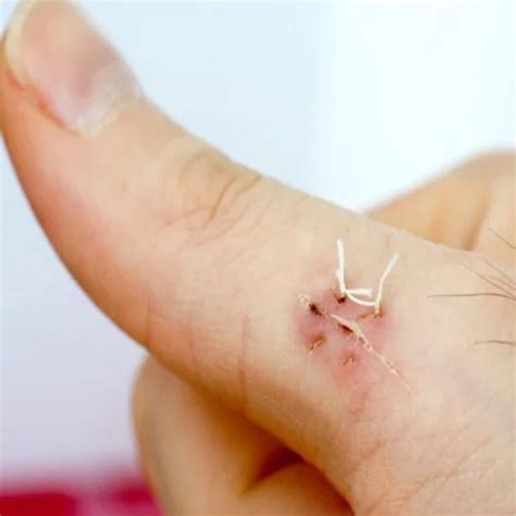 How Long Do Dissolvable Stitches Take To Dissolve Wisdom Teeth Dane101