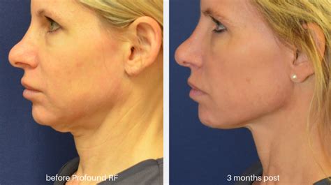 Best Non Surgical Treatment For Sagging Jowls Yoko Mcmillian
