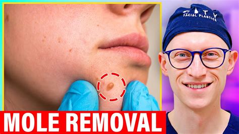 How To Get Rid Of Facial Mole Forever Gentnews