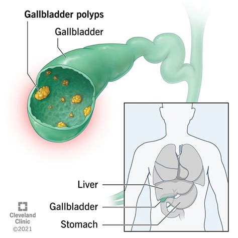 Gallbladder Polyps Symptoms Causes What It Is 2023