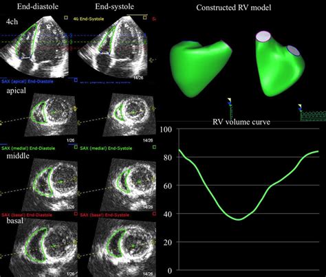 Prognostic Value Of Right Ventricular Ejection Fraction Assessed By
