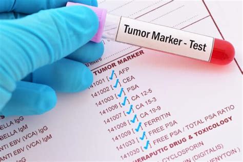 Ca 153 Tumor Marker Blood Test Why And How Is It Done