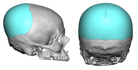Plastic Surgery Case Study Custom Skull Implant For Flat Back Of The