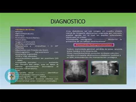 ADRIANA MENDEZ PROFESORA ENFERMERIA ADULTO Y ANCIANO CLASE DE PIELONEFRITIS YouTube