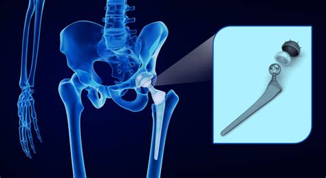 The Story Behind Defective Hip Implants