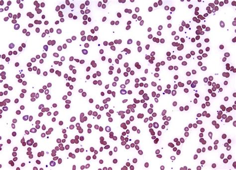 Hemolytic Anemia At 20x Magnification Microscopyu