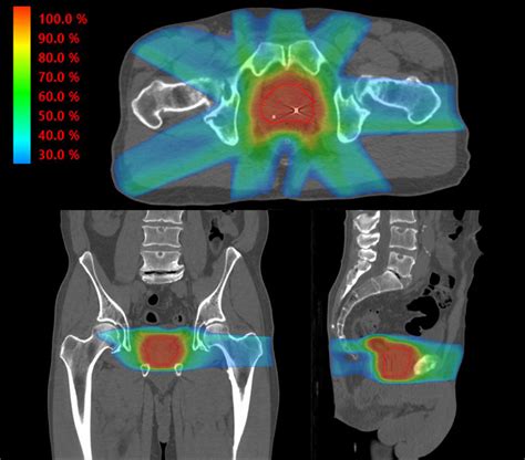 Illustrative Imrt Plan Treating The Prostate And Proximal Seminal Download Scientific Diagram