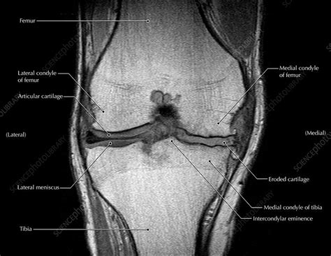 Knee Arthritis MRI Stock Image C027 1212 Science Photo Library