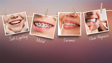 What Are The Different Types Of Braces Available Houston