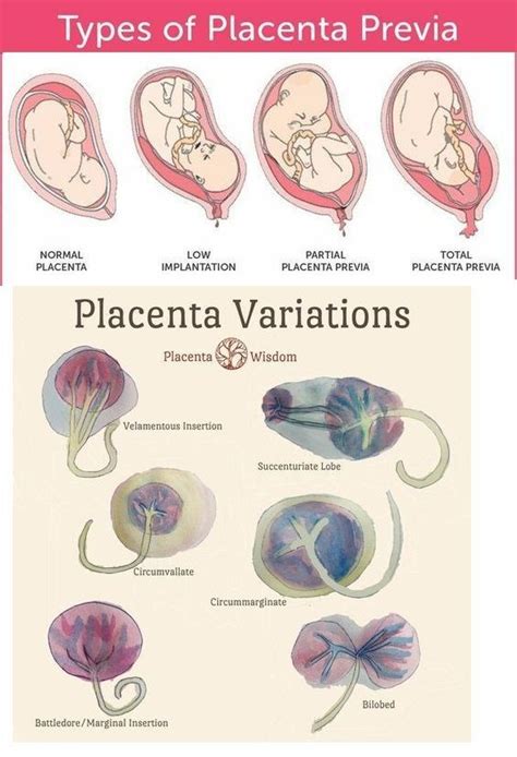Placenta previa refers to an abnormally low lying placenta such that it lies close to, or covers the internal cervical os. Placenta variations and what they look like | Nursing ...