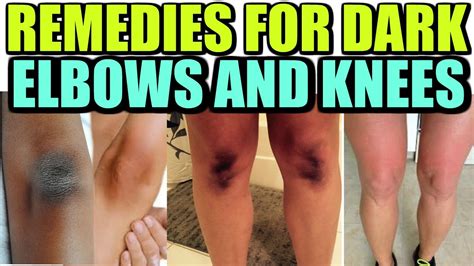 how to get get rid of dark elbows and knees fast tips superprincessjo youtube