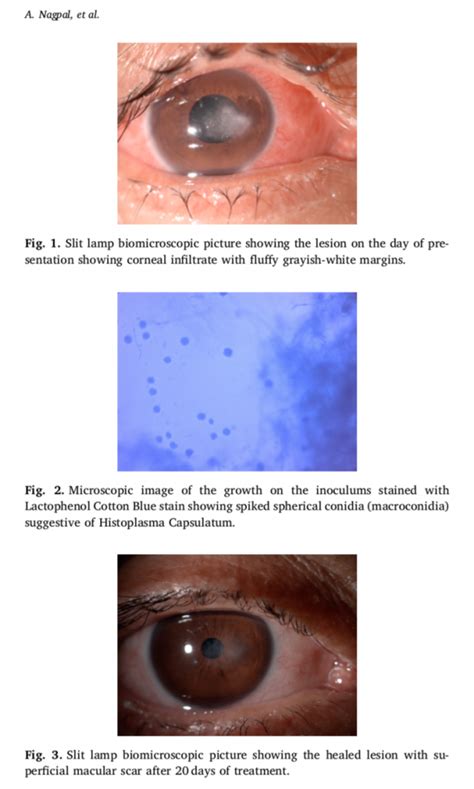 Our Publication In Journal Of Eucornea On A Rare Corneal Infection Dr