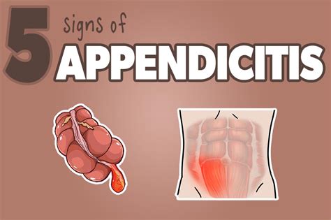 5 Appendicitis Signs You Dont Want To Miss Health And Willness