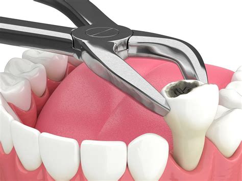 How To Prevent Dry Sockets After Wisdom Teeth Extraction Board Certified Periodontists