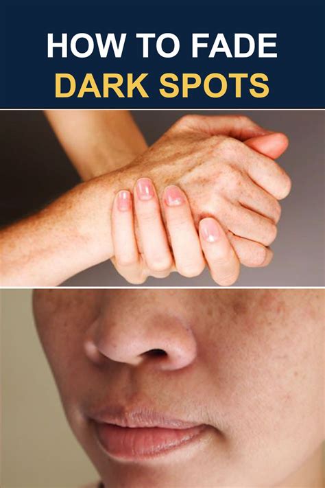 How To Fade Dark Spots Naturally How To Fade Fade Dark Spots Dark Spots