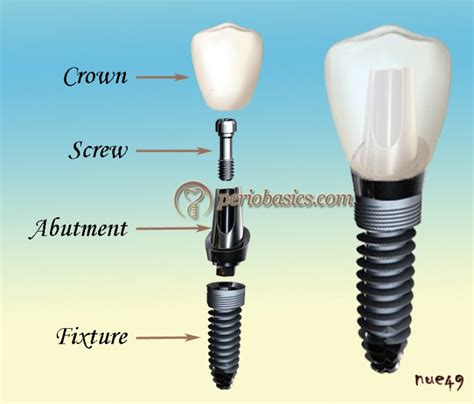 Dental Implant Components And Current Concepts In Implant Design