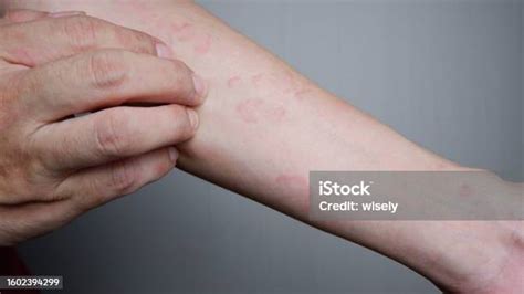 Close Up Image Of Arm Suffering Severe Urticaria Or Hives Or Kaligata