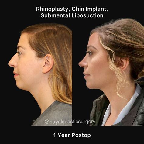 Plastic Surgery Before And After Chin