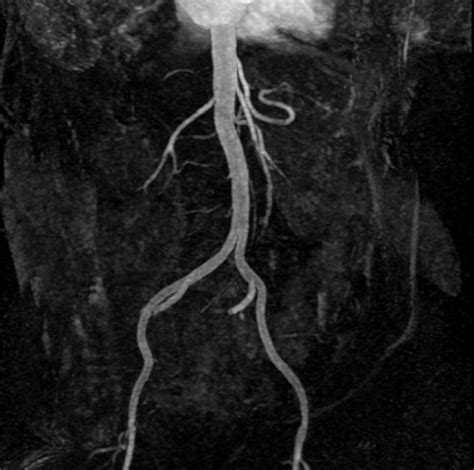 Peripheral Arterial Occlusive Disease Mra Radiology Case