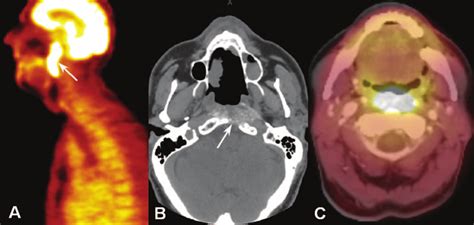 Pharyngeal Teflon Granuloma Case 1 A Sagittal Pet Scan Shows A