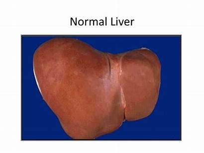 Liver Normal Metabolism Presentation Cirrhosis Dysfunction Drugs