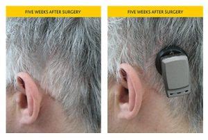 How Much Does Cochlear Implant Surgery Cost In 2024