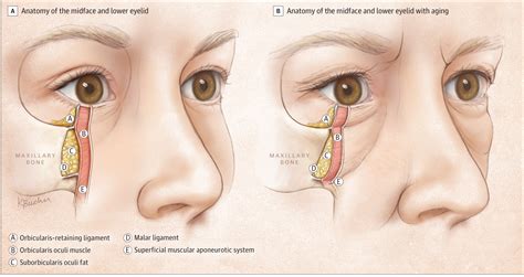 Biplanar Contour Oriented Approach To Lower Eyelid And Midface