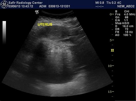 Dermoid Cyst Of The Ovary Image