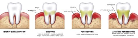 Gum Disease Burlington Nc Treatment For Gingivitis
