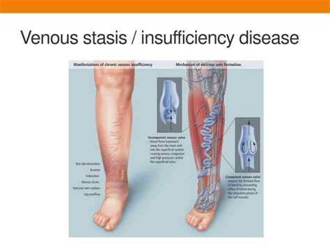 Ppt Venous Stasis Management And Ulcer Healing Powerpoint