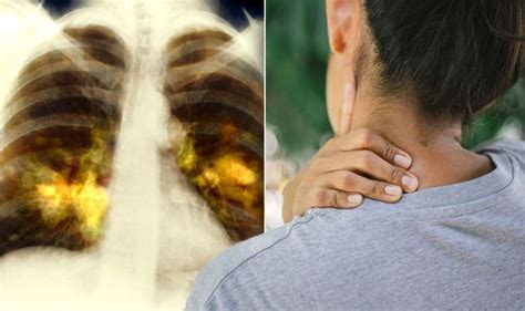 Lung Cancer Warning The Three Unusual Signs Of The Disease You Should