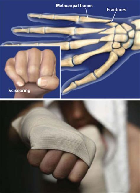 Fractures Of The Hand Metacarpal Fractures Central Coast Orthopedic