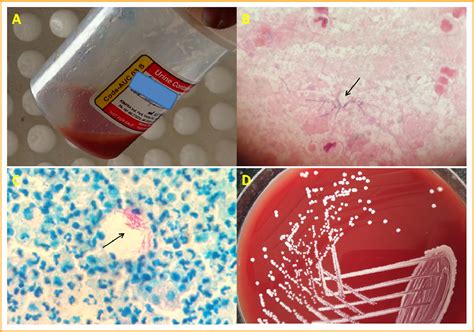 Modified Acid Fast Stain In The Diagnosis Of Nocardia Infection A