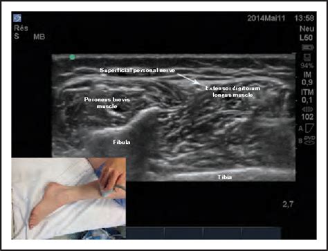 Figure 9 From Use Of Ultrasound For Lower Extremity Semantic Scholar