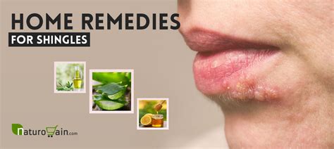 9 Effective And Best Home Remedies For Shingles