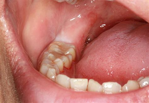 Roste zub moudrosti a bolesti dásní co dělat jak zmírnit bolest