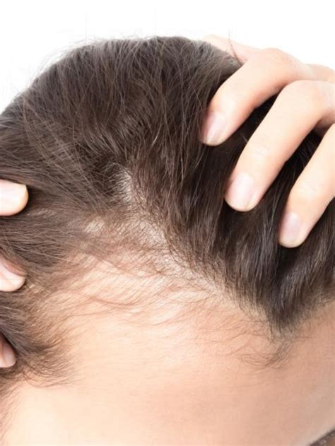 10 Home Remedies To Regrow Hair On Bald Patches In Pics