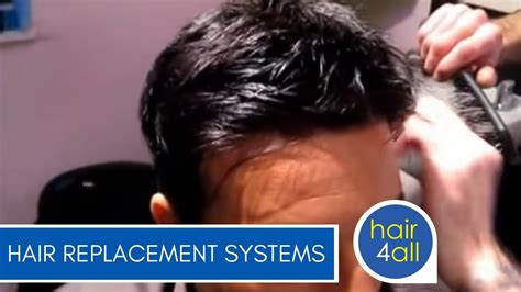 Before And After Results Of Our Non Surgical Hair Replacement System For Men Women Youtube