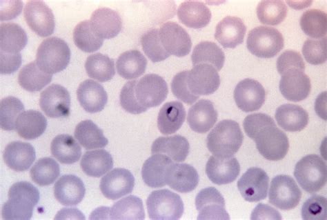 Free Picture Micrograph Plasmodium Malariae Ring Form Trophozoite