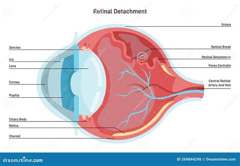 Retinal Detachment Emergency Situation In Which A Thin Layer Of Tissue