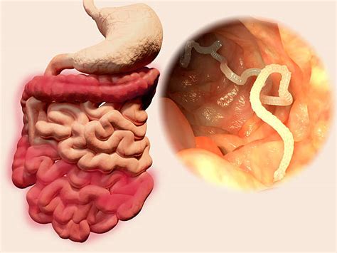 Pictures Of Worms In Humans Medquit