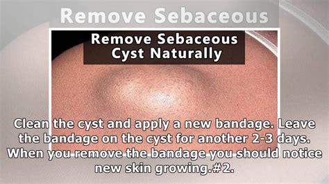 Best Home Remedies For Sebaceous Cysts Youtube
