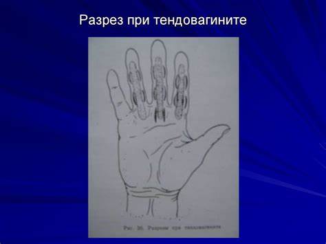 Диета при тендовагините Гнойные заболевания пальцев и кисти - презентация онлайн Гнойные заболевания пальцев и кисти - презентация онлайн Диета при тендовагините