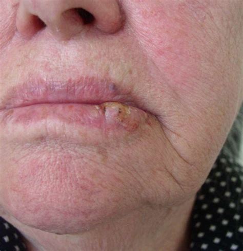 Lip Cancer Sign And Symptoms Pictures And Treatment