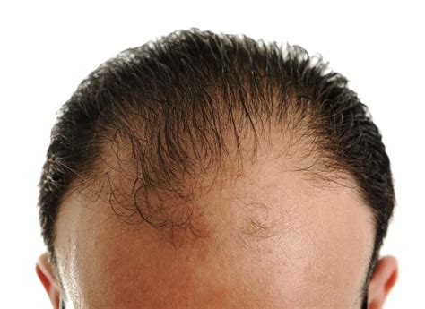 Best Hairdo For A Guy With A Receded Hairline Razor Look Full