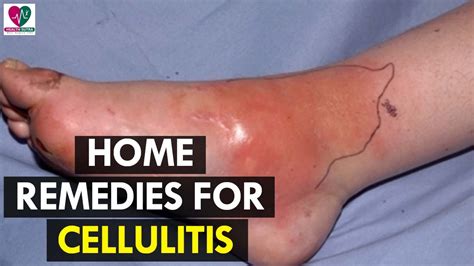 Home Remedies For Cellulitis Health Sutra Youtube