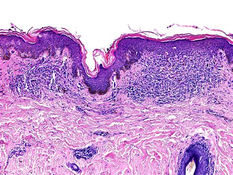 Pathology Outlines Lichen Nitidus